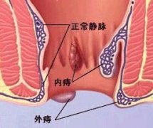 痔疮的病因