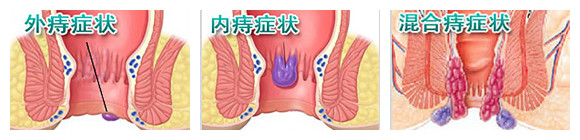 三种痔疮的症状