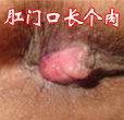 肛门口长个肉