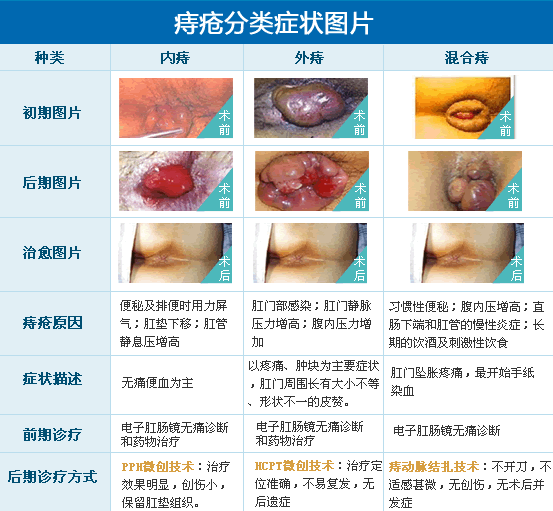 内痔、外痔、混合痔分类症状图片