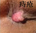 痔疮长什么样？痔疮的症状图片