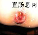 直肠息肉的症状有哪些？