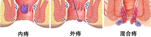 内痔、外痔、混合痔的症状图片