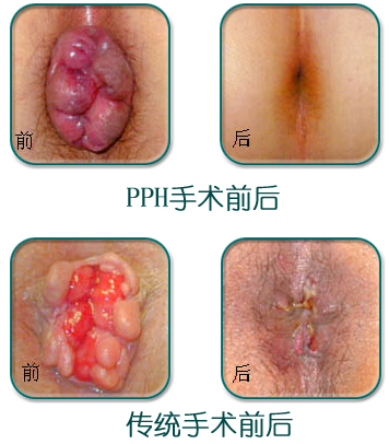 PPH手术前后对比