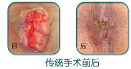 痔疮传统手术费用，点击咨询