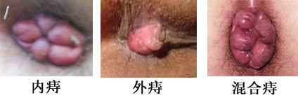 内痔、外痔、混合痔的图片